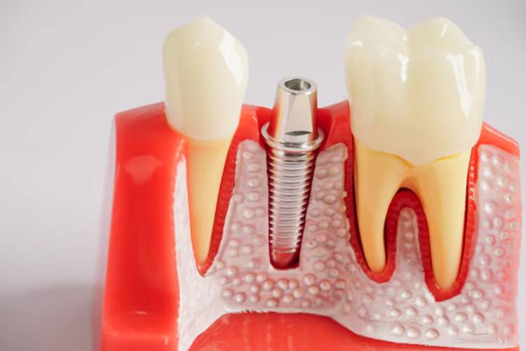 dental implant process and CDCP dental implant coverage for seniors