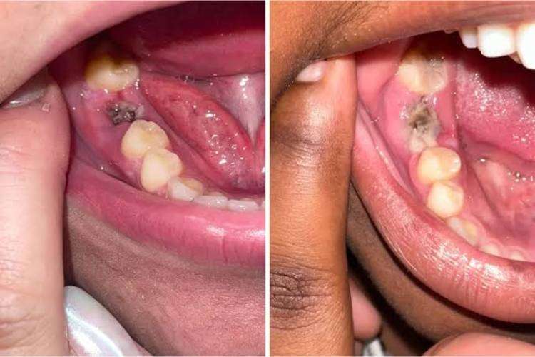 Tooth extraction aftercare