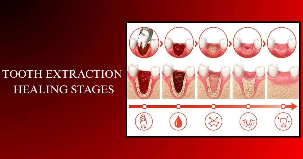 Tooth extraction aftercare